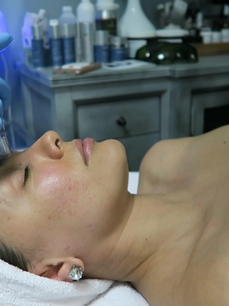 My Skin pen Experience