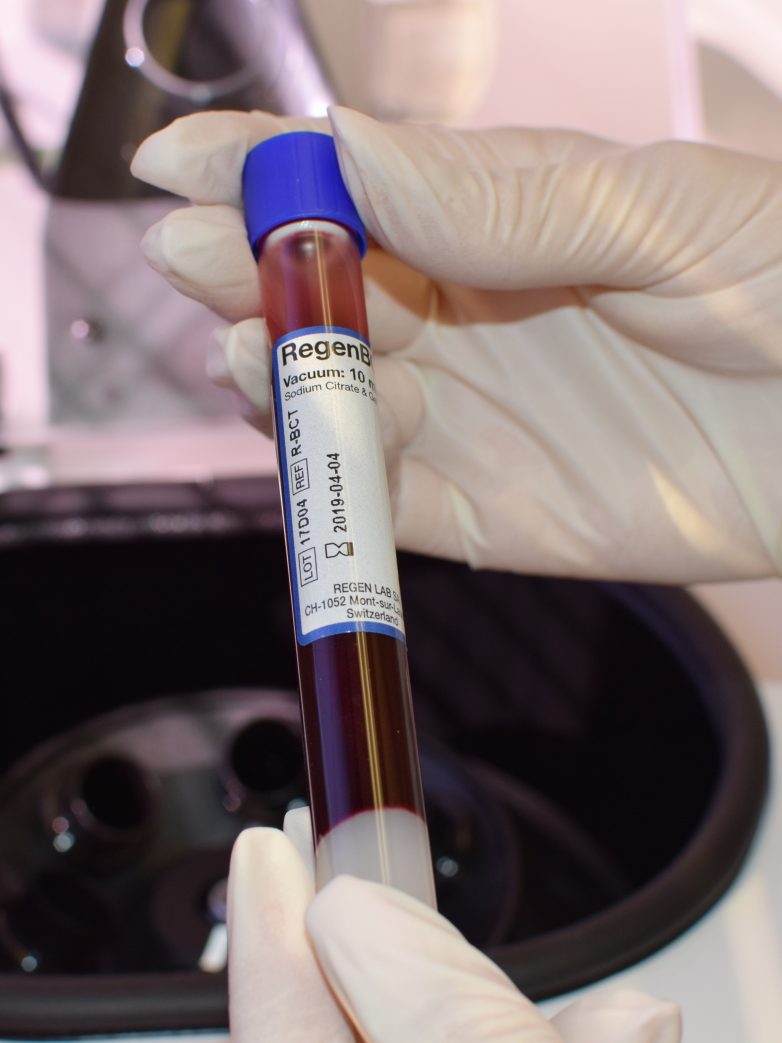 Vampire Facial at More Beautiful Skin Plastic Surgery