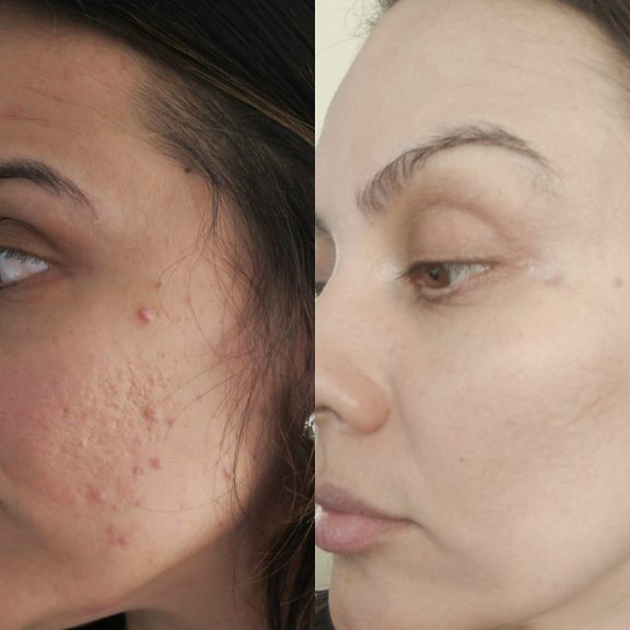 How I Got Rid Of My Acne Scars From Home