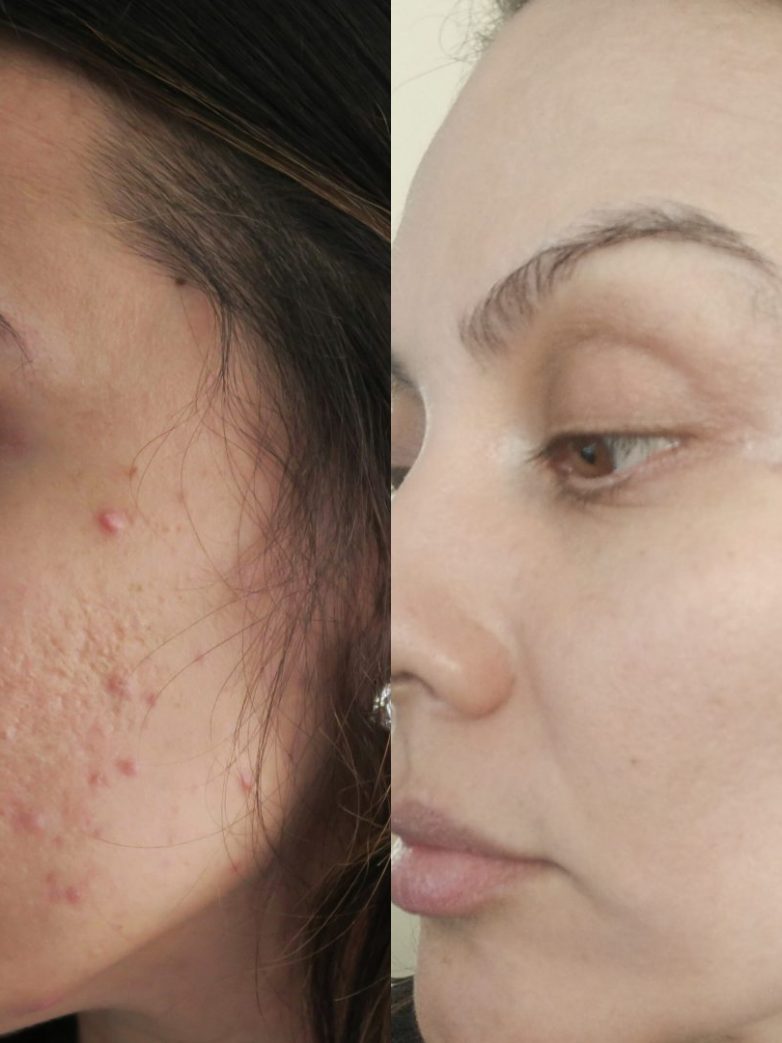 How I Got Rid Of My Acne Scars From Home